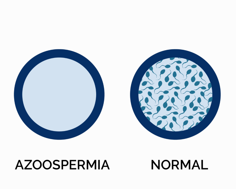azoospermia memahami kondisi tanpa sperma