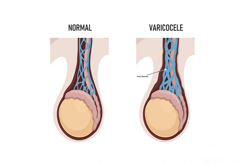 Penyebab Varikokel Pada Pria