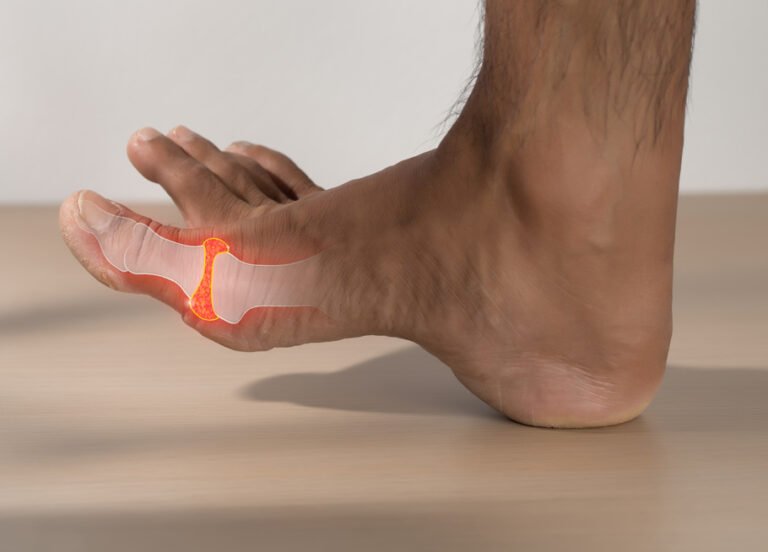 nyeri sendi asam urat afiapro