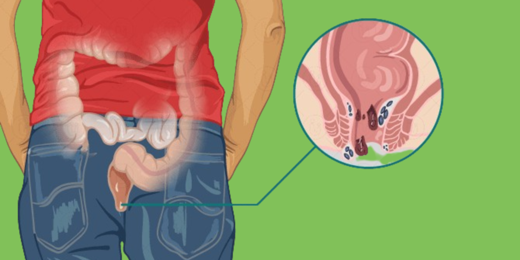 Hemotera Obat Wasir Alami