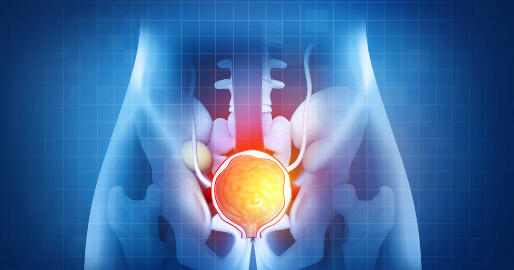 Prosterafit Untuk Prostat Jinak