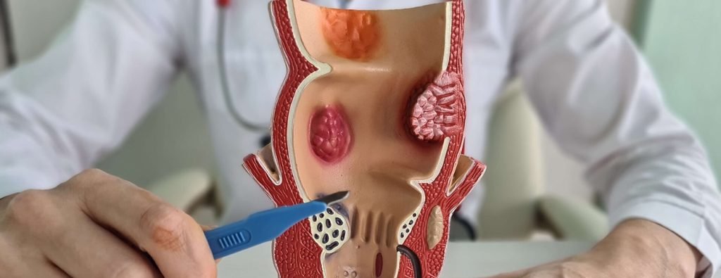 mengecilkan benjolan wasir hemotera