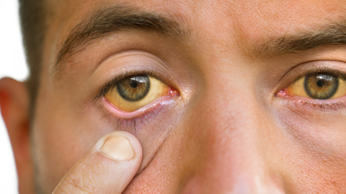 Gejala Awal Penyakit Hepatitis yang Jarang Disadari