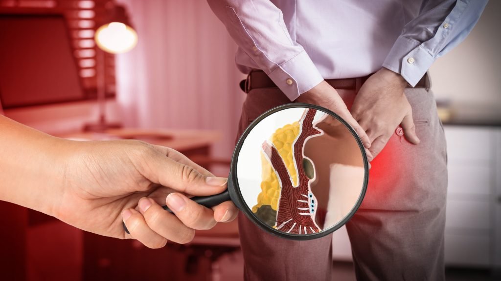 akibat wasir kronis hemotera