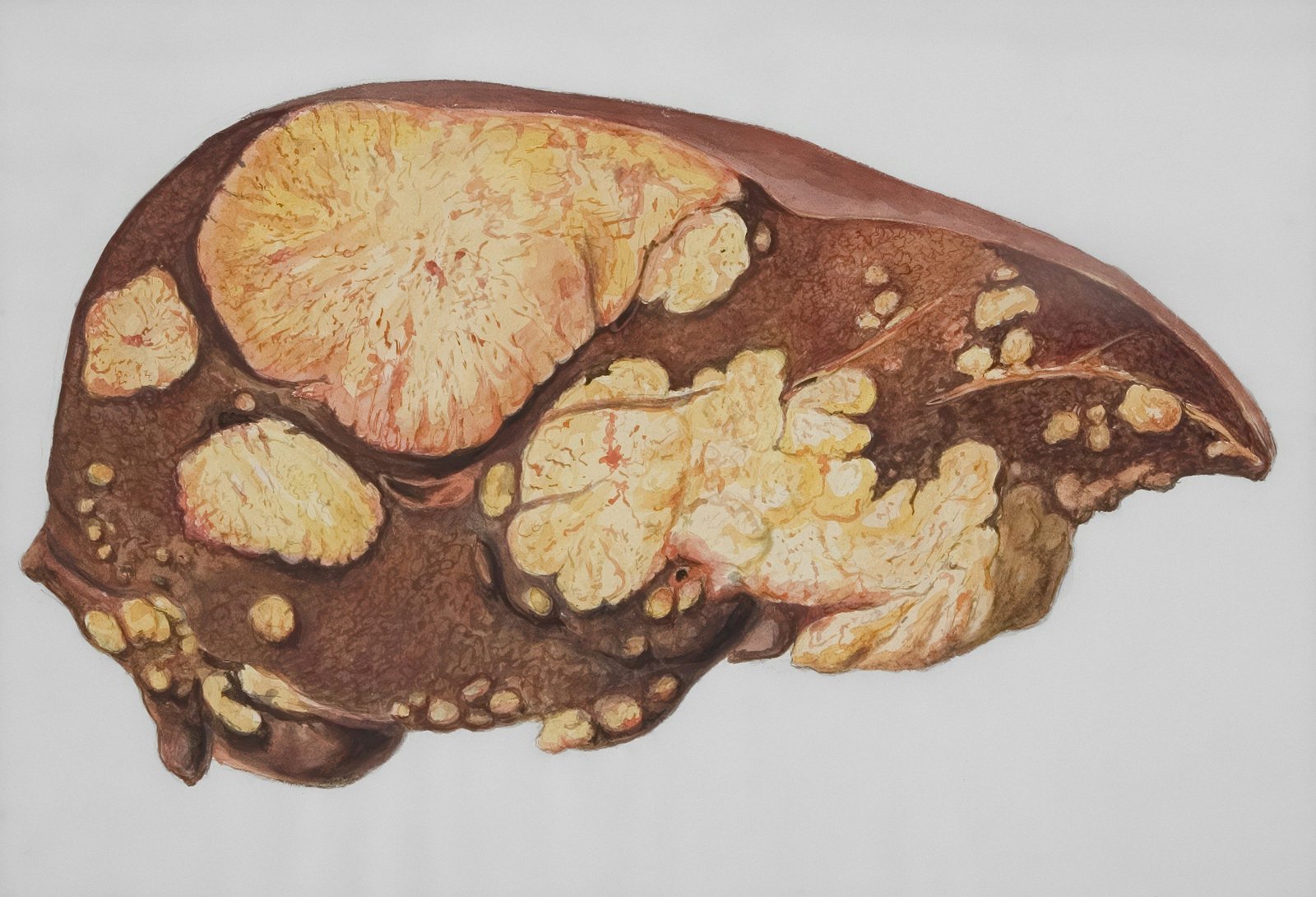 Penyebab penyakit liver