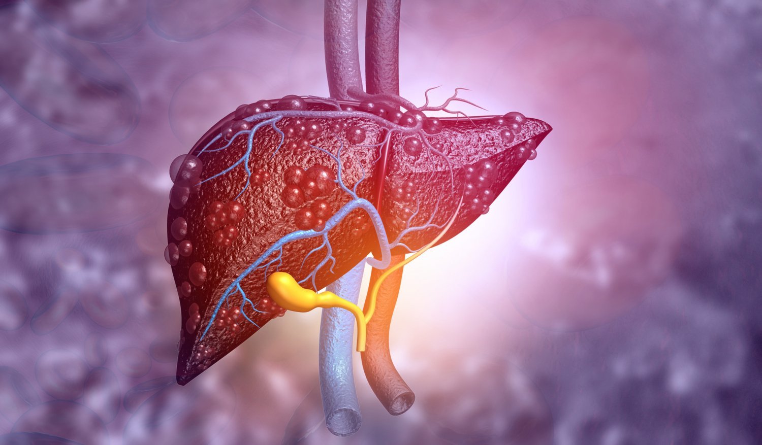Resiko Hati Berlemak Cara Pencegahan Paling Tepat
