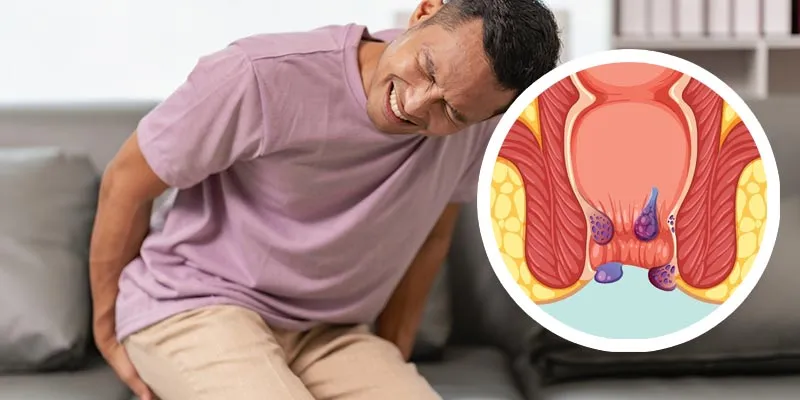 hemotera gejala wasir luar dan dalam