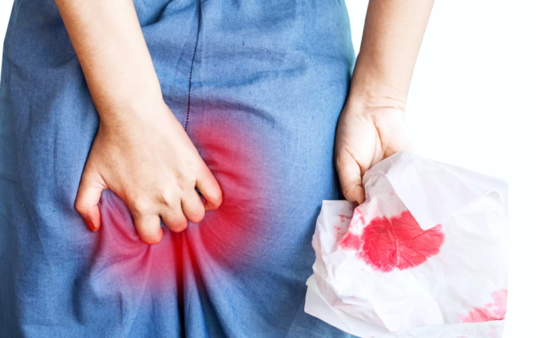 hemotera perbedaan wasir dan ambeien