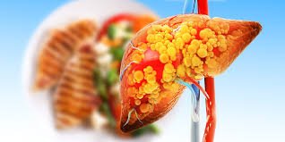mengenal fatty liver gejala penyebab dan cara mengatasi