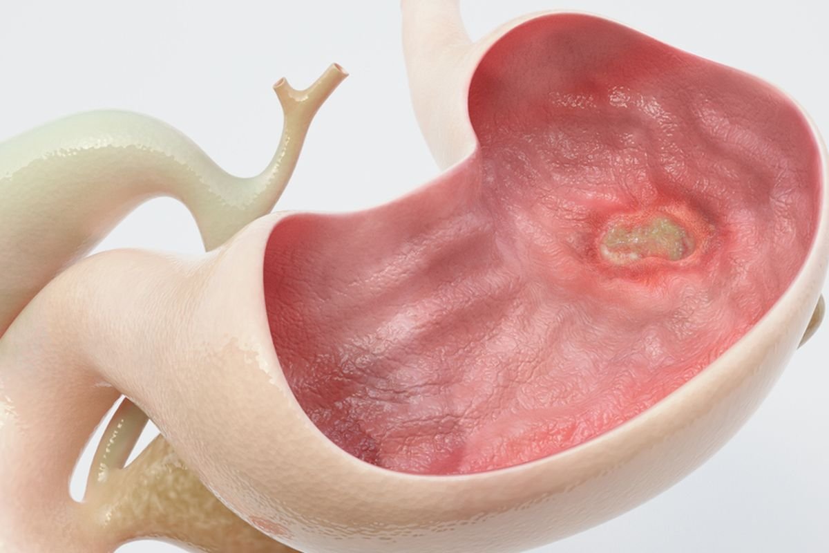 gejala tukak lambung soluma