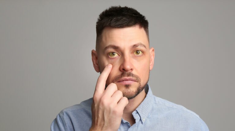 Apa Ciri Penyakit Liver Sudah Parah