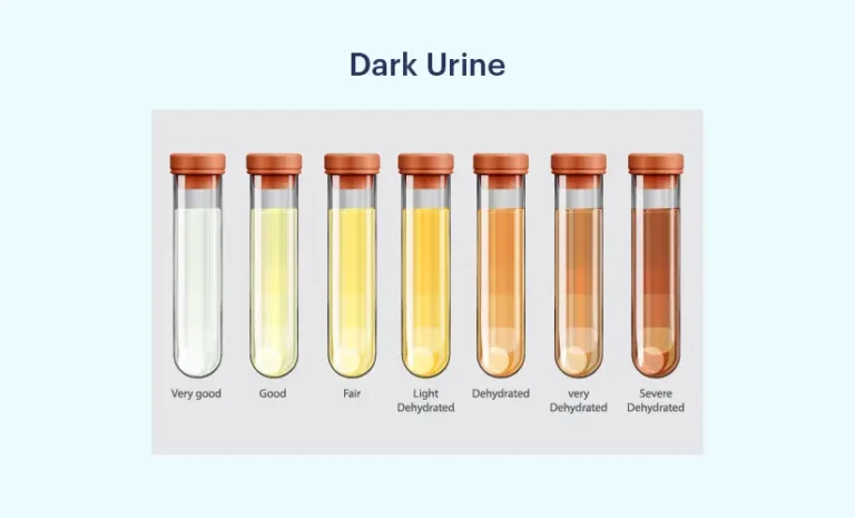 Herbatitis Penyebab Warna Urine Gelap