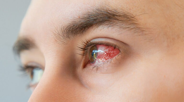 Mata Merah Penyebab Infeksi dan Cara Mengobatinya