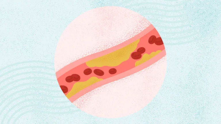 afiapro Komplikasi Kolesterol Tinggi