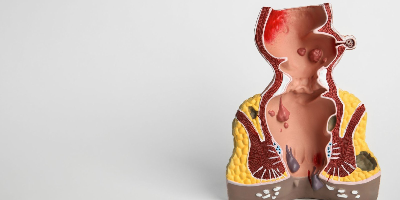 hemotera Benjolan Wasir