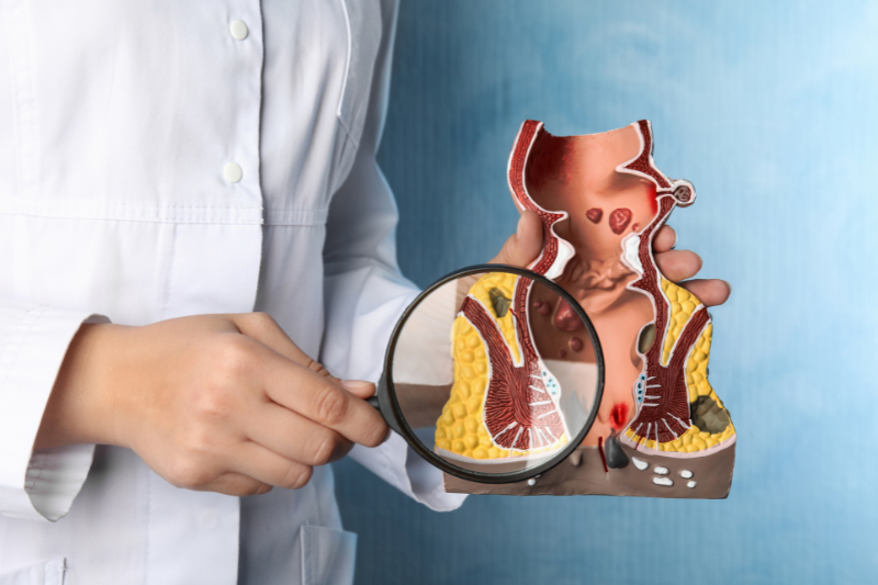 hemotera wasir kempes