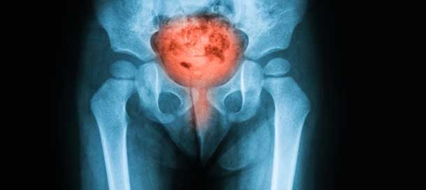 prosterafit jenis gangguan buang air kecil