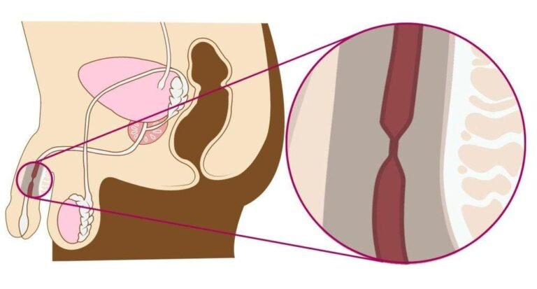 prosterafit penyempitan saluran kemih