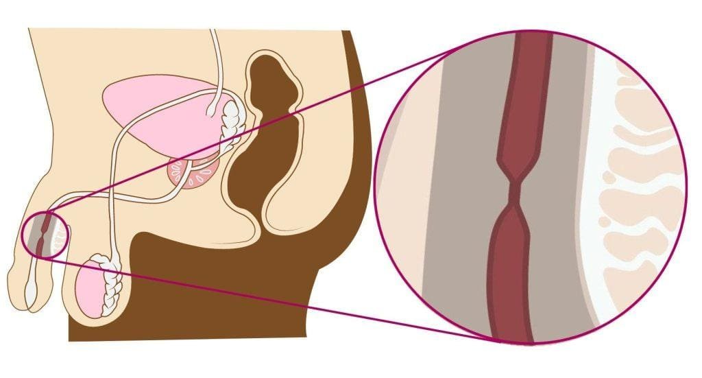 prosterafit penyempitan saluran kemih