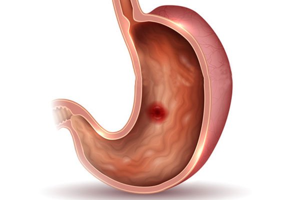 soluma tukak lambung menular