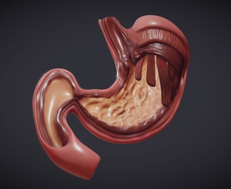 soluma diagnosis tukak lambung