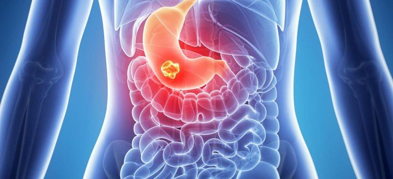 soluma organ lambung bermasalah