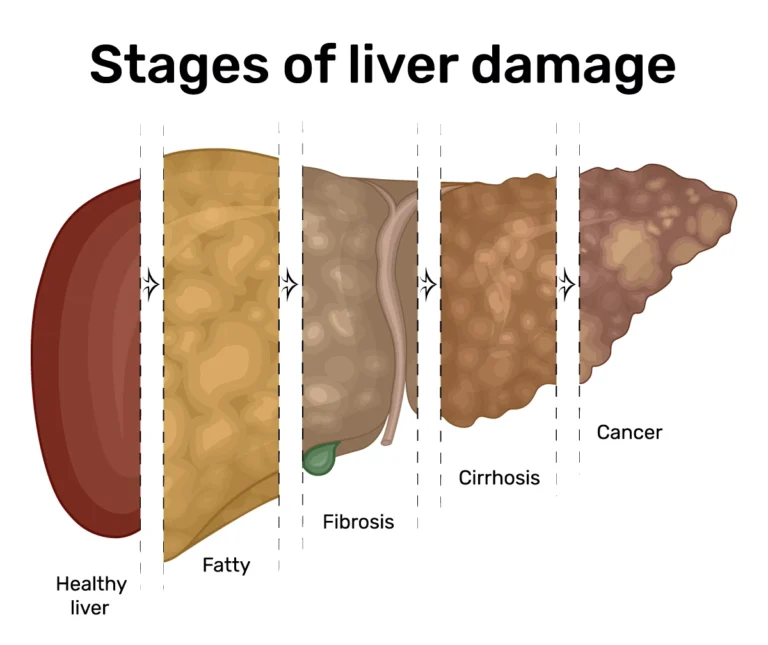 6 Komplikasi Penyakit Liver Berat yang Harus Diwaspadai