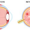 Cara Mencegah Penurunan Penglihatan Akibat Retinopati Diabetik