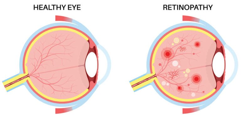 Cara Mencegah Penurunan Penglihatan Akibat Retinopati Diabetik