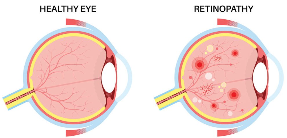Cara Mencegah Penurunan Penglihatan Akibat Retinopati Diabetik