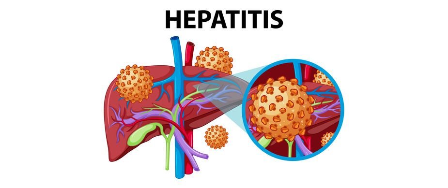 Dampak Infeksi Virus Hepatitis terhadap Gagal Hati