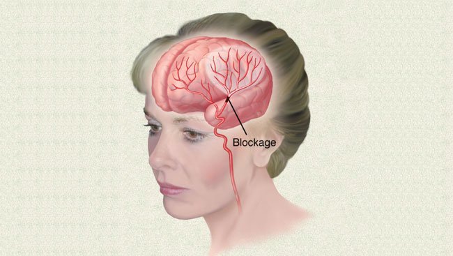 Darah Tinggi dan Risiko Stroke Penyumbatan Otak
