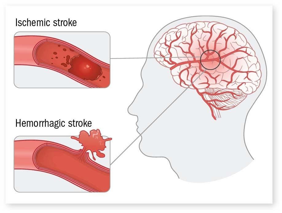 Hipertensi dan Stroke Hubungan Erat Penyebab Kematian