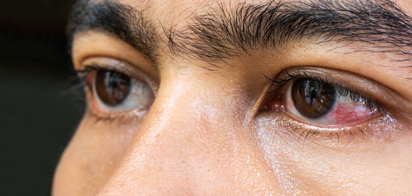 Mata Kabur Mendadak Kenali Retinopati Hipertensi, Komplikasi Darah Tinggi pada Mata