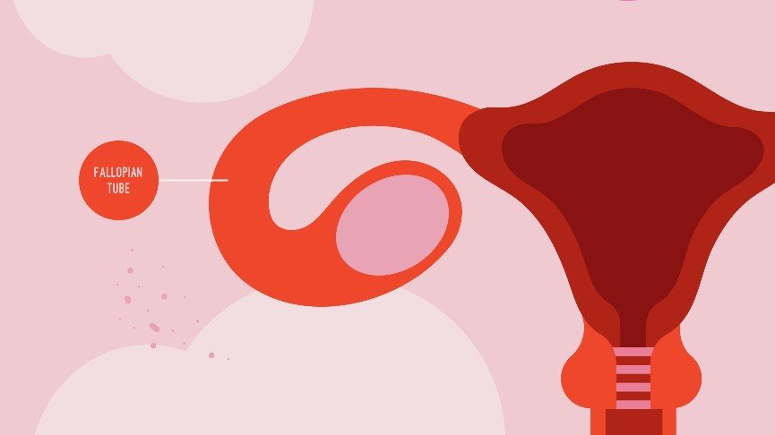 Sumbatan Tuba Falopi: Dampak Serius Infeksi yang Menghambat Kehamilan
