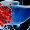 Tumor dan Kanker Hati Penyebab, Gejala, dan Metode Pengobatannya