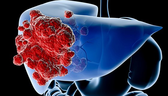 Tumor dan Kanker Hati Penyebab, Gejala, dan Metode Pengobatannya