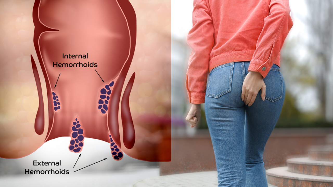 hemotera wasir internal keluar anus