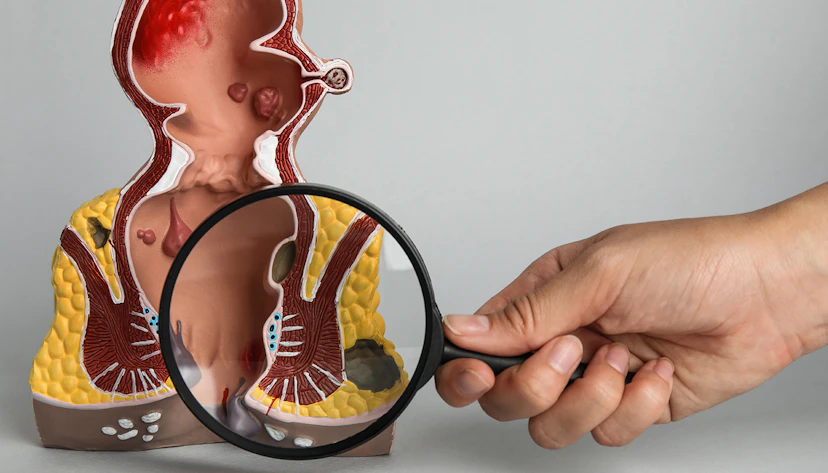 hemotera ciri wasir stadium 3