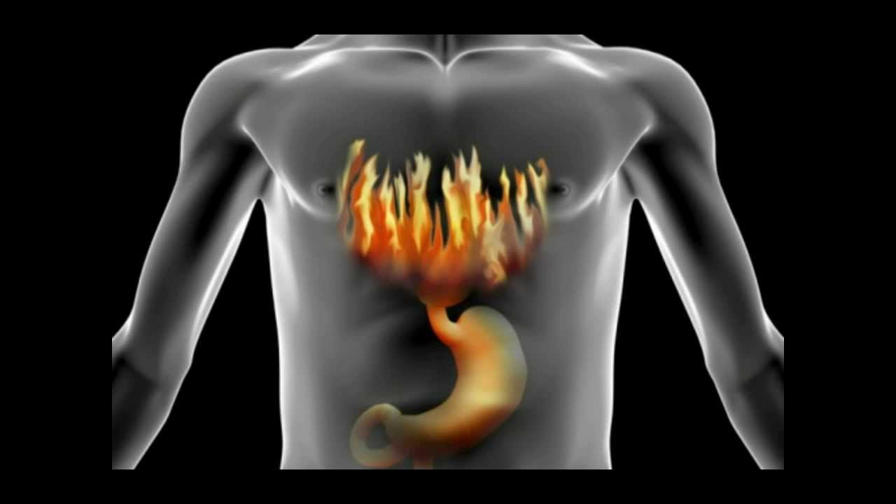 soluma rasa terbakar di dada