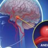 Aneurisma Otak Ancaman Nyawa Akibat Hipertensi