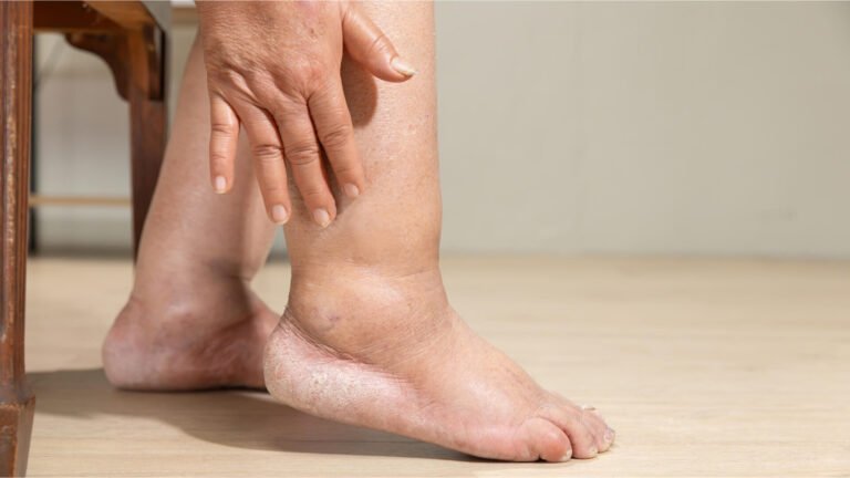 Awas, Hipertensi yang Dibiarkan Bisa Sebabkan Penyakit Arteri Perifer