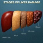 Bahaya Gagal Hati Akut Kondisi Darurat yang Mengancam Nyawa