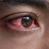Cara Membedakan Mata Merah Biasa dan Infeksi Menular