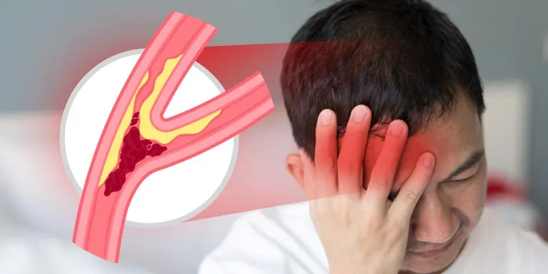 Kelumpuhan Akibat Stroke Dampak Fatal Hipertensi