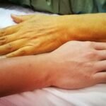 Kulit dan Mata Menguning Kenali Gejala Penyakit Kuning