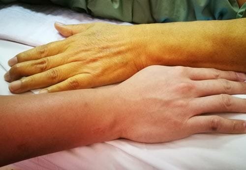 Kulit dan Mata Menguning Kenali Gejala Penyakit Kuning