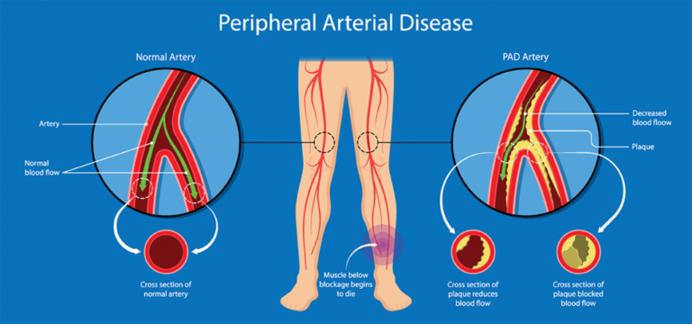 Mengenal Penyakit Arteri Perifer, Komplikasi Serius dari Darah Tinggi