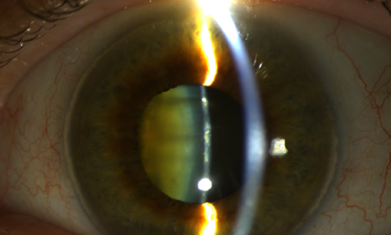 Mengenali Tanda Awal Katarak Sejak Dini dan Cara Mencegahnya