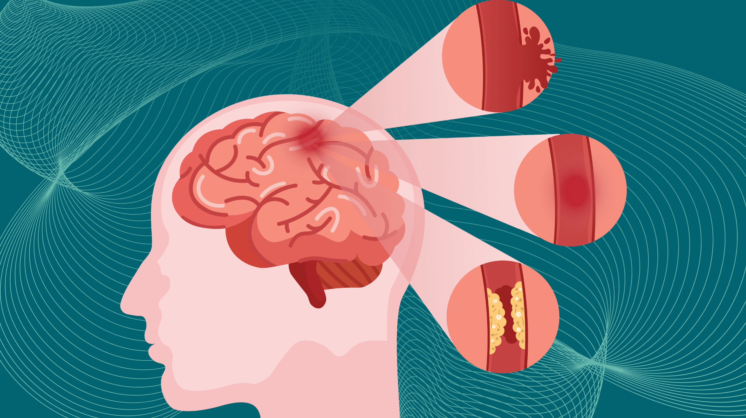Penyebab Utama Stroke Darah Tinggi Tak Terkontrol